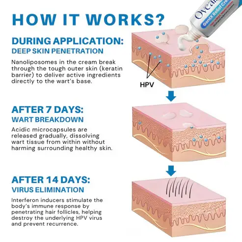 Oveallgo® HPV Genital Warts Relief Cream 5 Oveallgo® HPV Genital Warts Relief Cream
