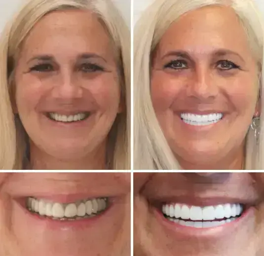 INSIDEEFY™ – Advanced Customized Full Denture Set 3 INSIDEEFY™ – Advanced Customized Full Denture Set