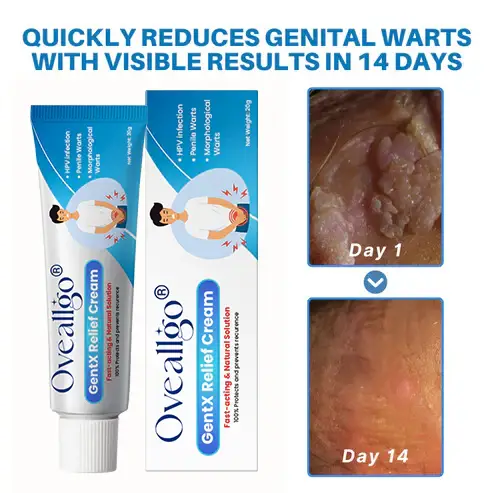 Oveallgo® HPV Genital Warts Relief Cream 4 Oveallgo® HPV Genital Warts Relief Cream