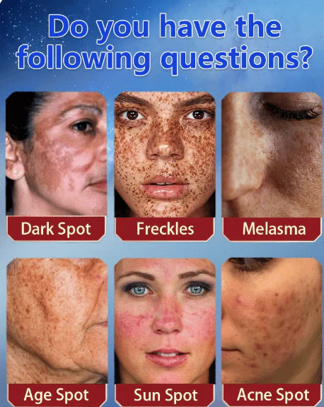 Bikenda™️ Blemish Removing Beauty Cream 2 Bikenda™️ Blemish Removing Beauty Cream